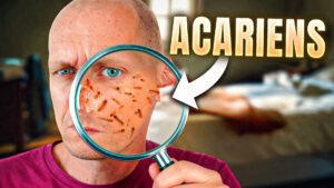 Les acariens de la peau